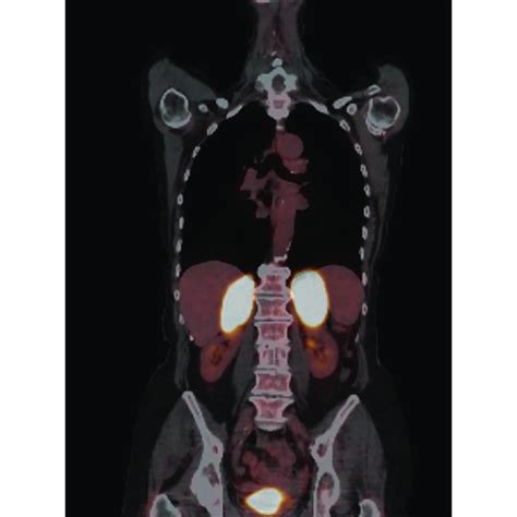 Ct Scan Of Patient 2 Showing Bilateral Homogeneous Enlarged Adrenal