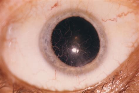 Corneal Dystrophy Lattice Type I Hereditary Ocular Diseases