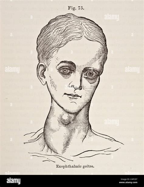 Illustration Of Exophthalmic Goitre Circa 1881 Stock Photo Alamy