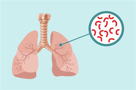 Faktor Faktor Yang Berkaitan Dengan Kejadian Tuberculosis Di Sidoarjo