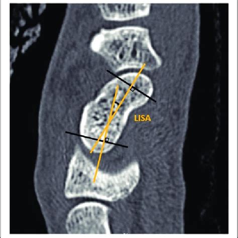 The Measurement Of Lateral Intrascaphoid Angle Lisa As The Acute