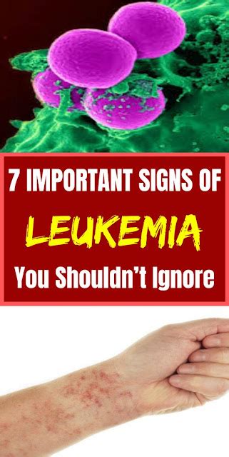 7 Important Signs Of Leukemia You Shouldnt Ignore Wellness Days