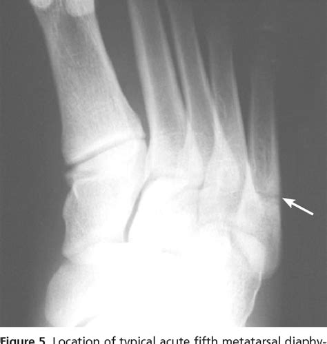 Figure 11 From Diagnosis And Management Of Metatarsal Fractures