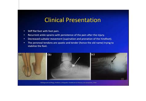 Tarsal Coalition And Peroneal Spastic Flatfoot —