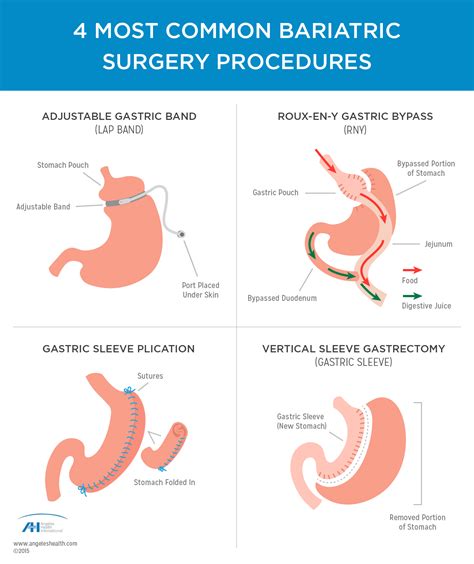 Top 90 Pictures Pictures Of Bariatric Surgery Latest