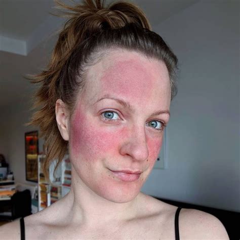 Rosacea Faqs Everything You Ever Wanted To Know But Were Afraid To