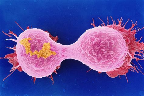 Researchers Identify Why Women May Develop Resistance To A New Class Of