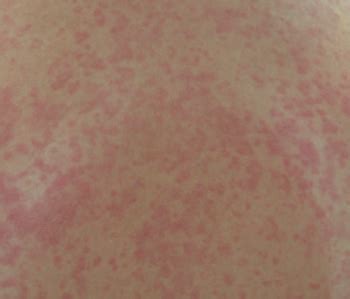 Many viral infections can cause a rash in addition to other symptoms. viral exanthem rash images : Inside the Clinic