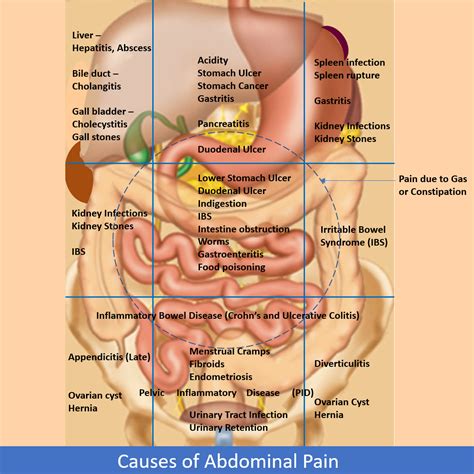Lower Left And Right Abdominal Pain Causes And Treatment Gambaran