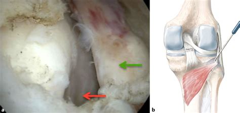 A B 9 The Popliteus Tendon Green Arrow Is Retracted With A Hook And
