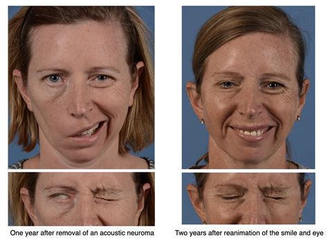 Bell S Palsy Facial Nerve Face Exercises Paralyzed Fa