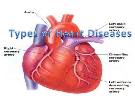 Different Types Of Heart Disease