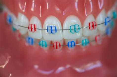 types of braces and invisible aligners reuland and barnhart orthodontics in tyler tx