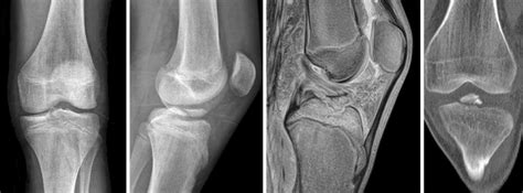 Standard Diagnosis Of Tibial Eminence Fracture Could Be Established