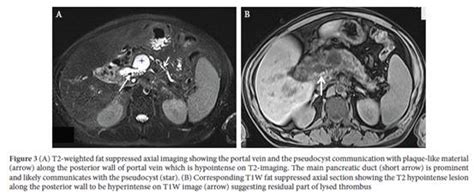 Mri Diagnosis Of Rupture Of Pancreatic Pseudocyst Into