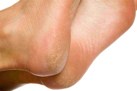 Can You Recognize Plantar Warts On Feet