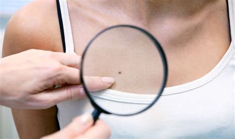 Skin Cancer Warning Itchy Spot Could Be Sign Other Than A Mole You Need To Watch Out For