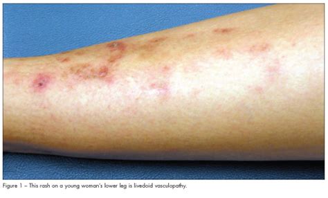 Teenager With Recalcitrant Rash And Lower Extremity Pain Consultant360