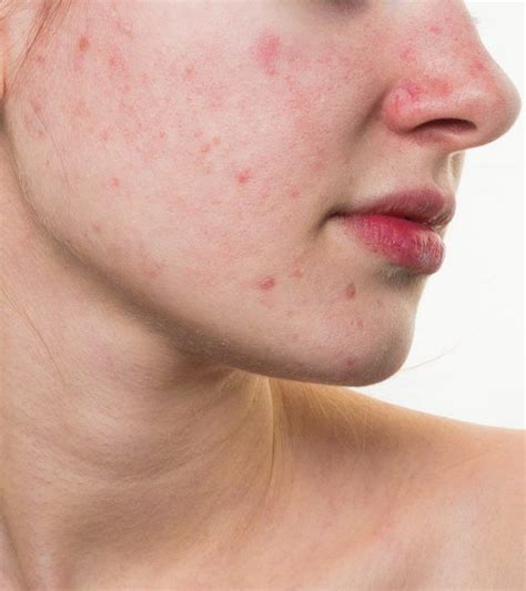 How To Get Rid Of Red Spots On Face 6 Home Remedies And Tips Red Bumps