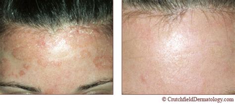 Crutchfield Dermatology Treatment Acne In Minnesota