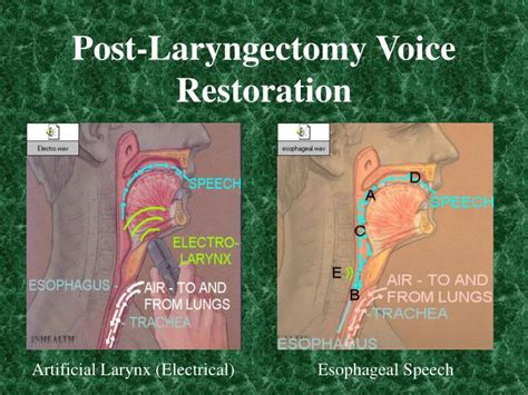 Ppt Tracheoesophageal Voice Prosthesis Insertion Kit Powerpoint