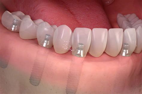 Top Reasons Why People Go Abroad For Dental Implants