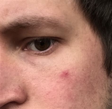 Red Spot Mark On Face For Years Wont Go Dermatology Skin And