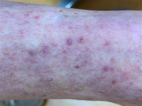 Purpura Pigmentosa Progressiva Ziekte Van Schamberg
