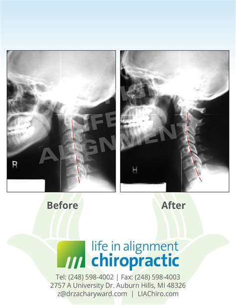 Upper Cervical Chiropractic Cases From Dr Zachary Ward Chiropractor