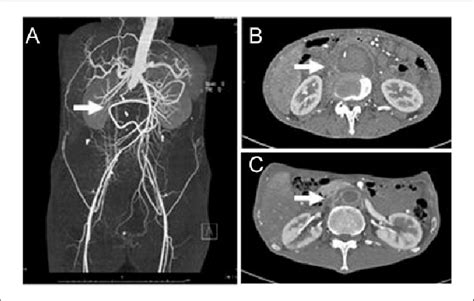 Computed Tomographic Angiography Cta Of Whole Abdomen A