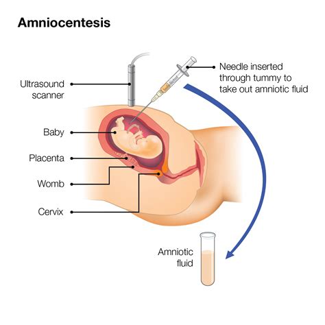 Amniocentesis Diagnostic Procedure Template