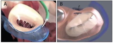 State Of The Art Of Transcatheter Mitral Annuloplasty Present And
