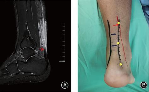 A New Technique Of Achilles Tendon Rupture Repaired By Double