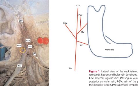 Figure 1 From Multiple Variations Of Superficial And Deep Veins In The