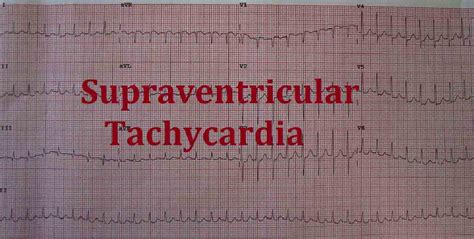 Ventricular Tachycardia Causes Symptoms And Treatment 2022
