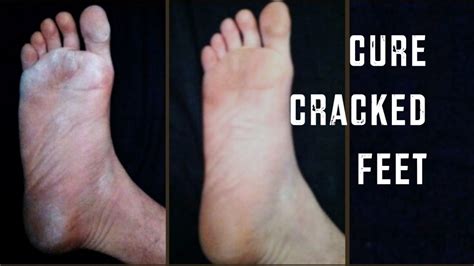 How To Cure Dry Cracked Feet Cheap Tip 165 Youtube