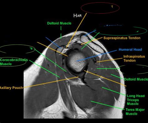 Shoulder Sagittal Oblique Mri 3 Diagram Quizlet