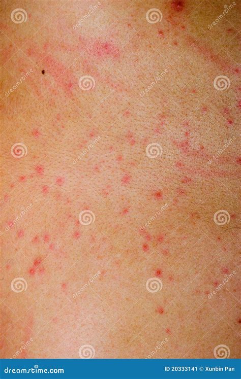 Allergic Rash Dermatitis Eczema Skin Of Patient Legs Royalty Free Stock