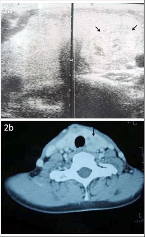 A Thyroid Ultrasound Displaying A Solitary Heterogeneous Nodule Which