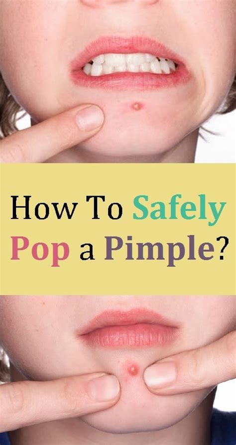 How To Safely Pop A Pimple In 2020 Pimples Facial Skin Care Pimple