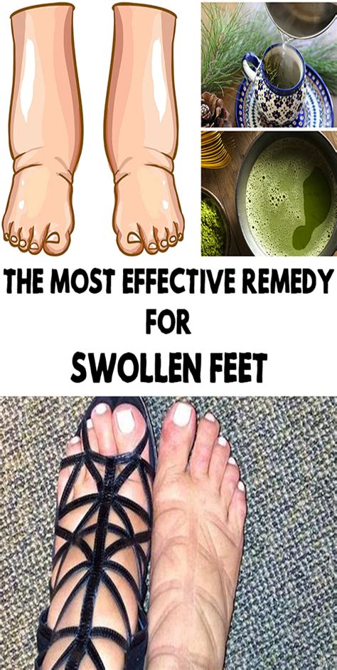 The Most Effective Remedy For Swollen Feet Foot Remedies Swollen