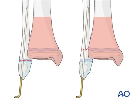 Open Reduction K Wire Fixation For Epi Metaphyseal Fractures Salter