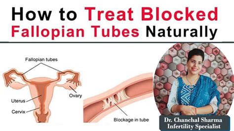 Natural Treatments For Blocked Fallopian Tubes Dr Chanchal Sharma