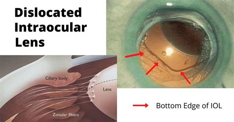 Dislocated Intraocular Lens Following Cataract Surgery Board