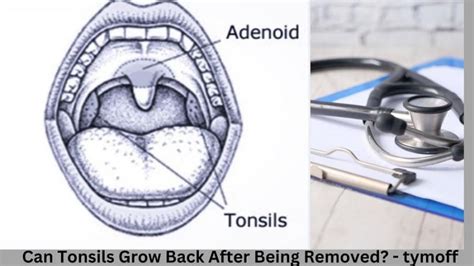 Can Tonsils Grow Back After Being Removed Tymoff