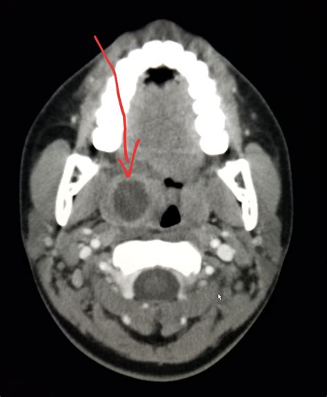 Ct Scan For Tonsils Ct Scan Machine