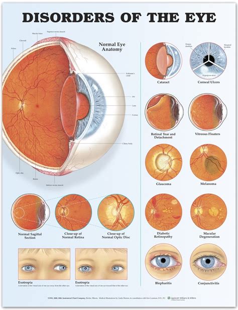 Disorders Of The Eye Infographic I Find This Particularly Useful When