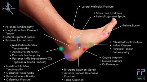 Foot Pain Chart Find The Cause Of Foot Pain With Our Diagram