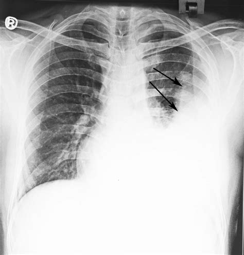Chest X Ray Posteroanterior View On Initial Presentation Showing