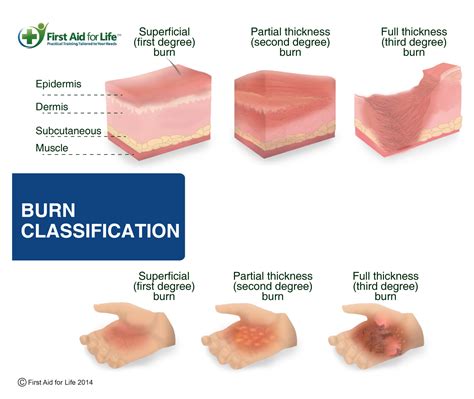 Types Classifications And Causes Of Burn Injuries Gambaran